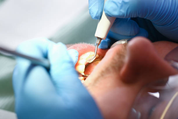 Best Root Canal Emergency Dentist  in Botkins, OH